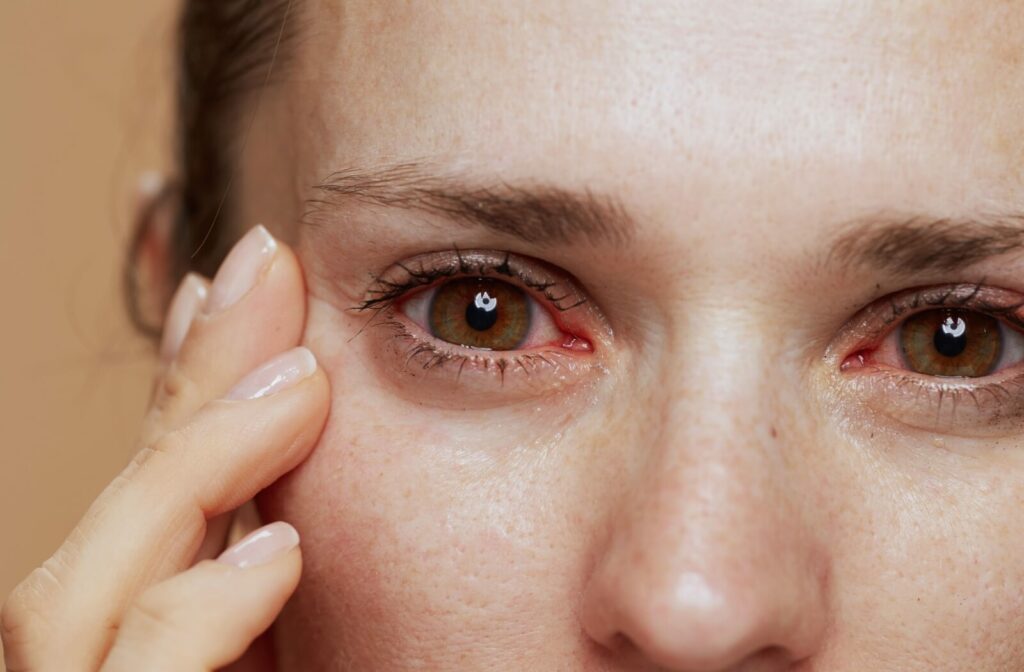 An adult woman putting her right hand on the side of her face highlighting her red and irritated eyes from dry eye.