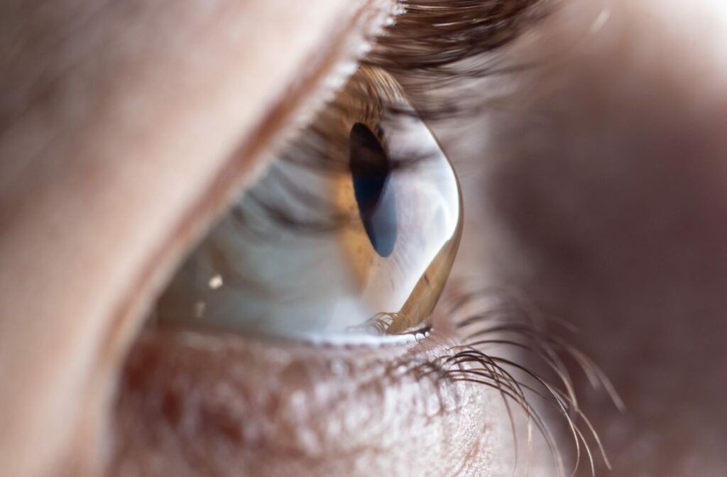 a close-up of a persons eye which exhibits signs for keratoconus, a condition that scleral lenses are ideal for.