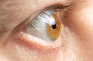 Close-up of an eye with keratoconus showing a cone-shaped cornea bulging outward, a key visual sign of the condition.