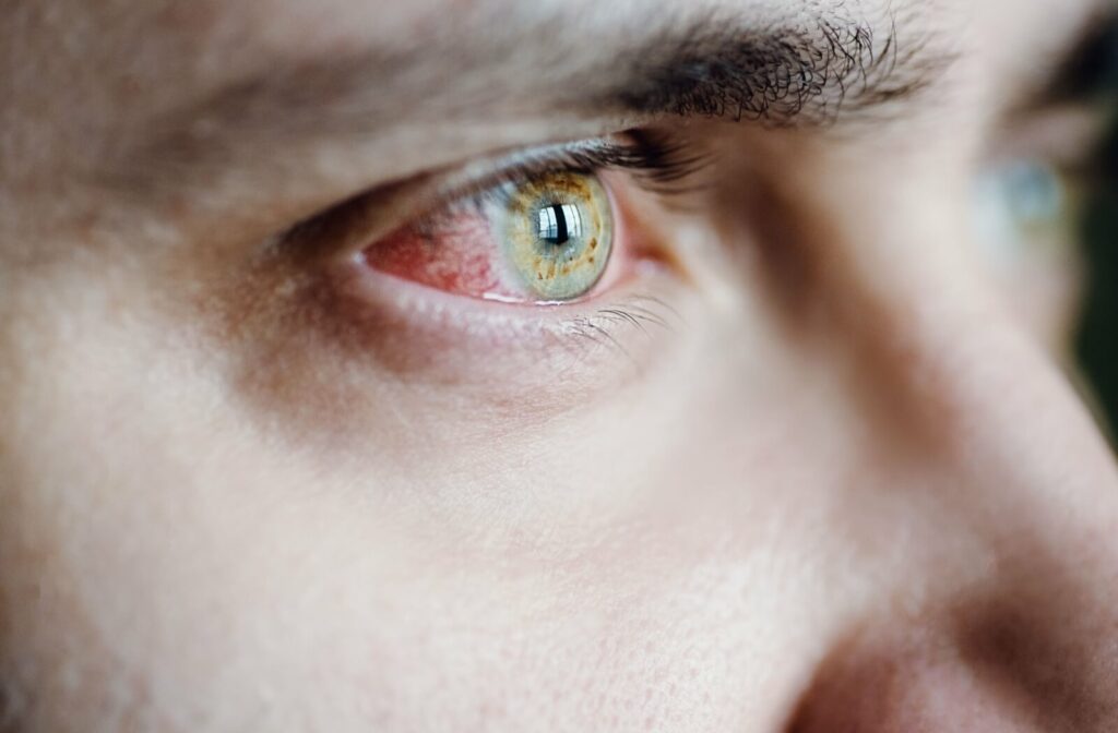 Close-up of a red, irritated eye showing symptoms commonly associated with sudden dry eye.