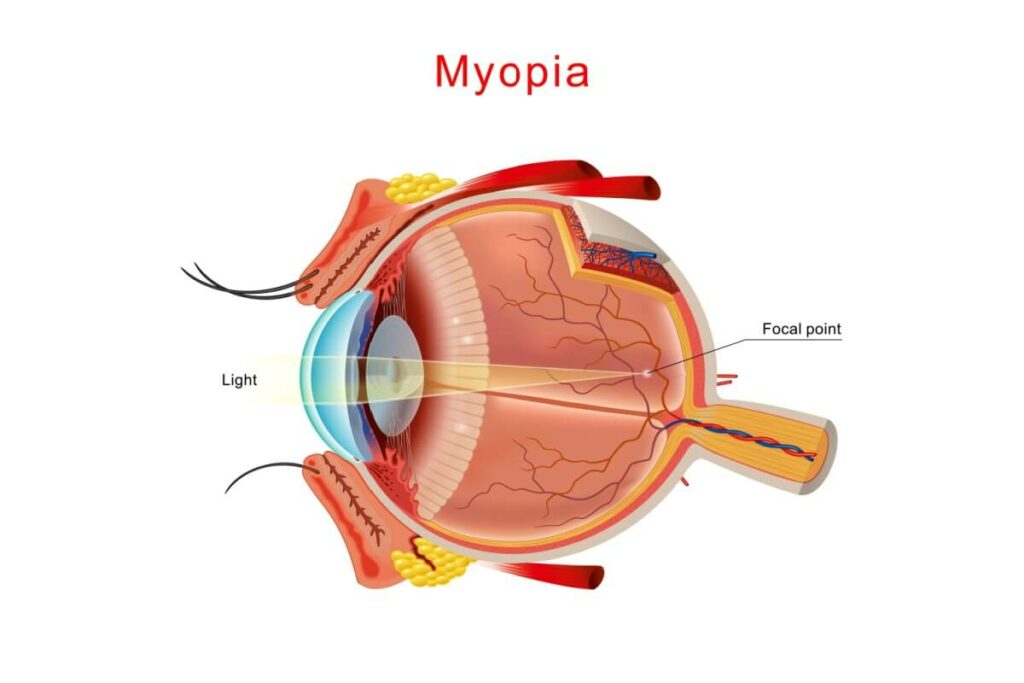 A medical diagram of an eye with myopia, showing light passing through the cornea and lens to form a focal point in front of the retina instead of directly on it.