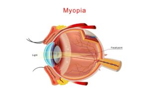 A medical diagram of an eye with myopia, showing light passing through the cornea and lens to form a focal point in front of the retina instead of directly on it.